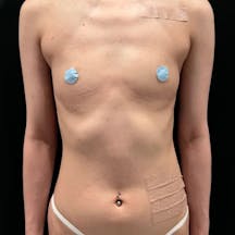 【女性・胸】CEREFORM(R)(セレフォーム)(バッグ豊胸)_before