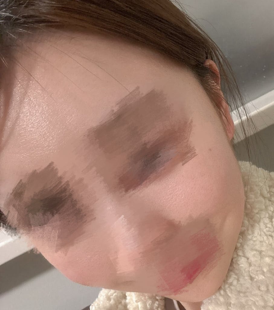 藤ナチュレ美容クリニック 銀座院でピコトーニング＋マッサージピール＋エレクトロポーション＋VISIA肌診断を受けたすてらさんの写真