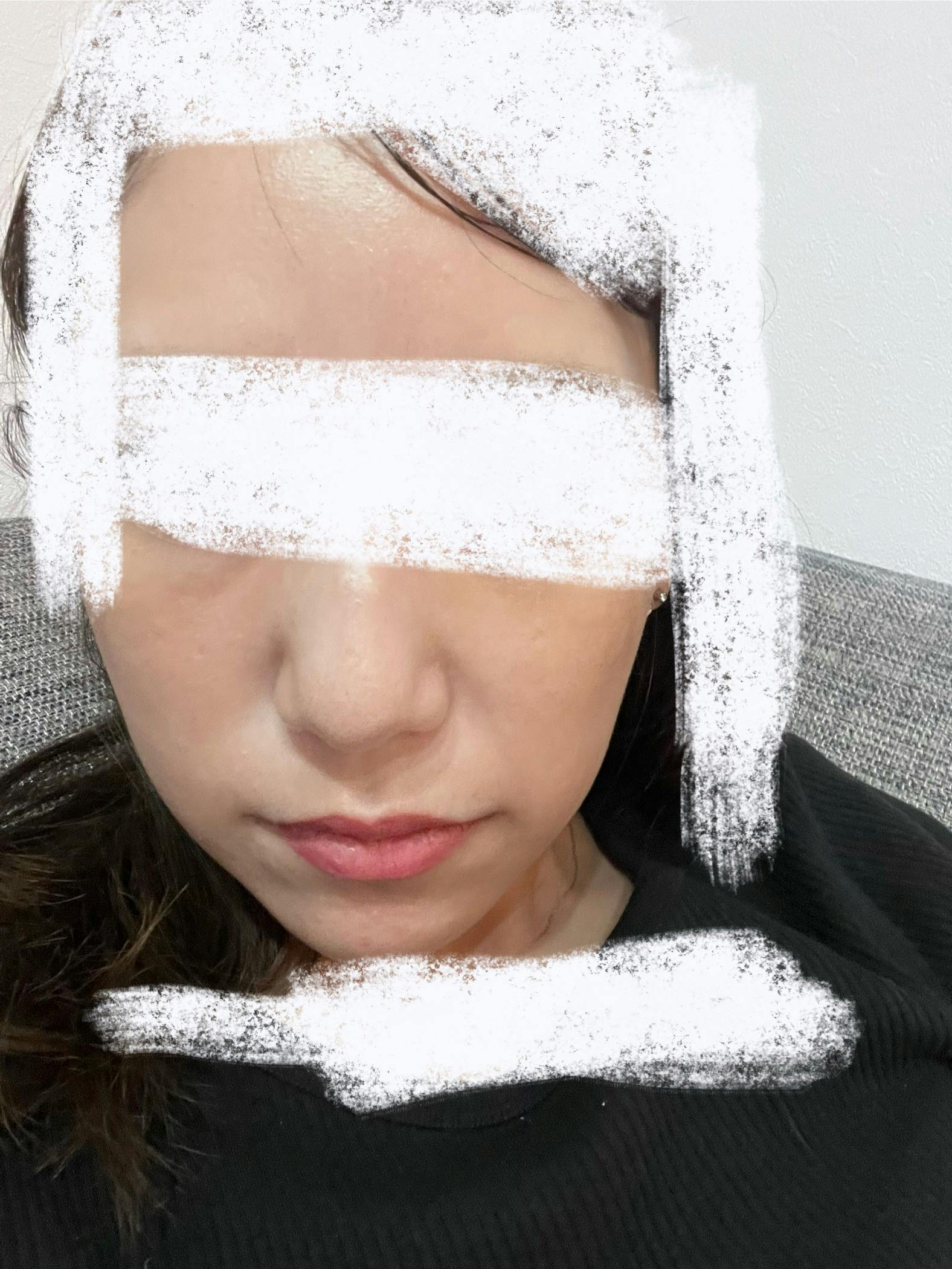 モーブビューティークリニック札幌大通(Mauve Beauty Clinic 札幌大通)でプラズマポレーションを受けたelleriさんの写真