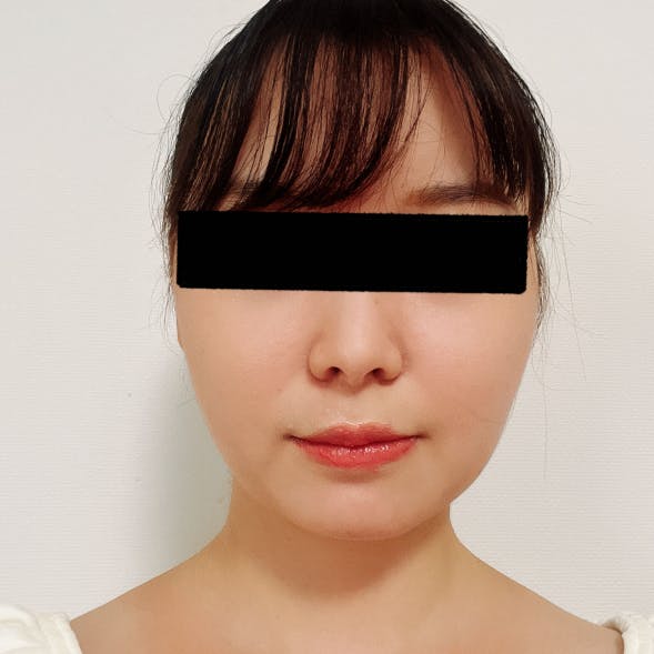 Mods Clinic（モッズクリニック）大阪院で頬・顎下脂肪吸引を受けたネコミミ侍さんの写真