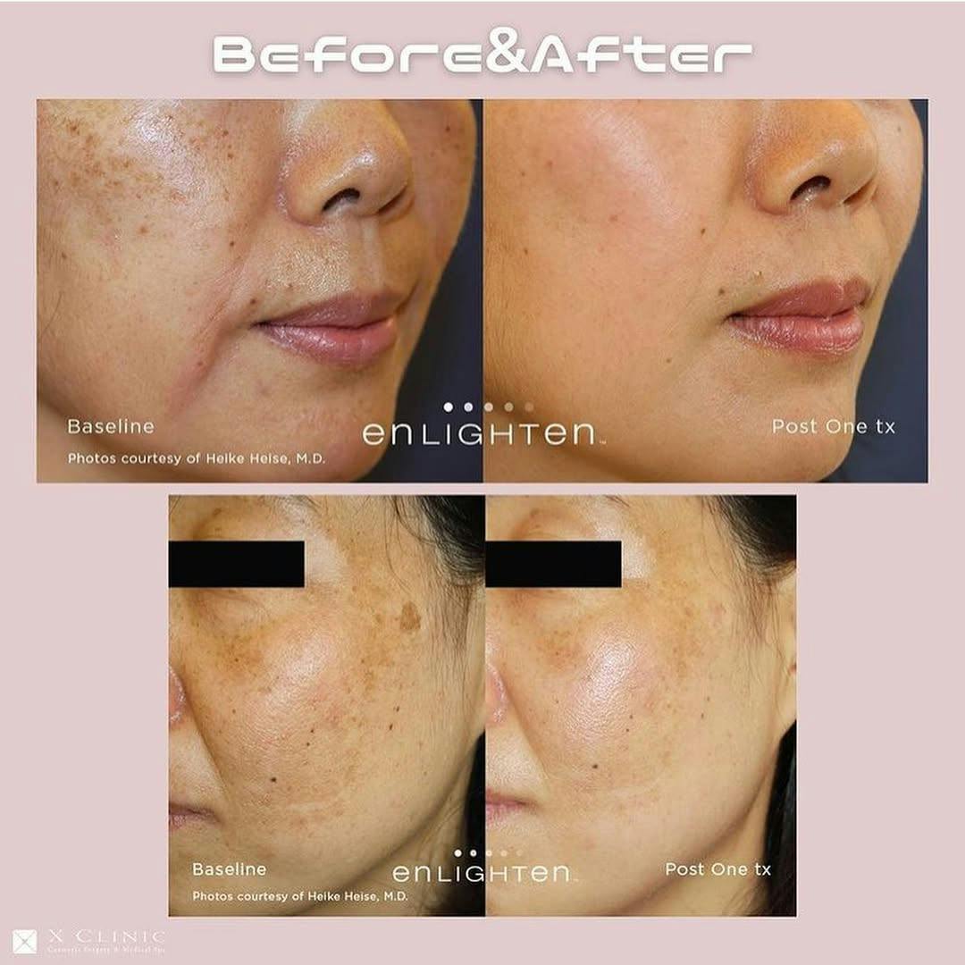 【女性・シミ】ピコトーニング_before_aftar