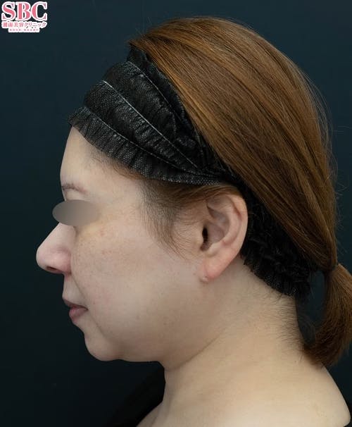 【40代女性・顔】Aquicell（アキーセル）脂肪吸引、ジョールファット除去術、メーラーファット除去術、VOVリフト_before