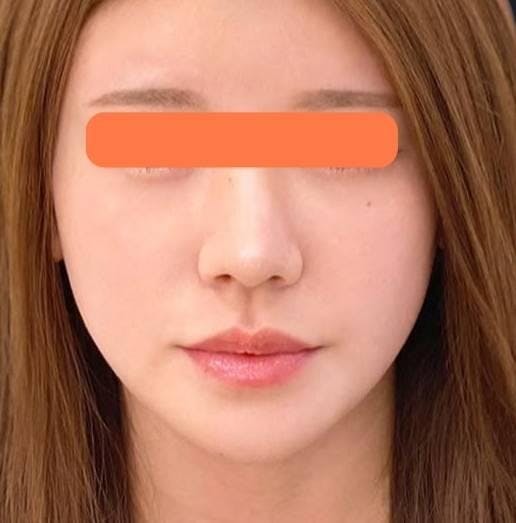美容皮膚科タカミクリニック シミ・美肌育成外来でたるみ治療：サーマクールCPTを受けたKANACoさんの写真