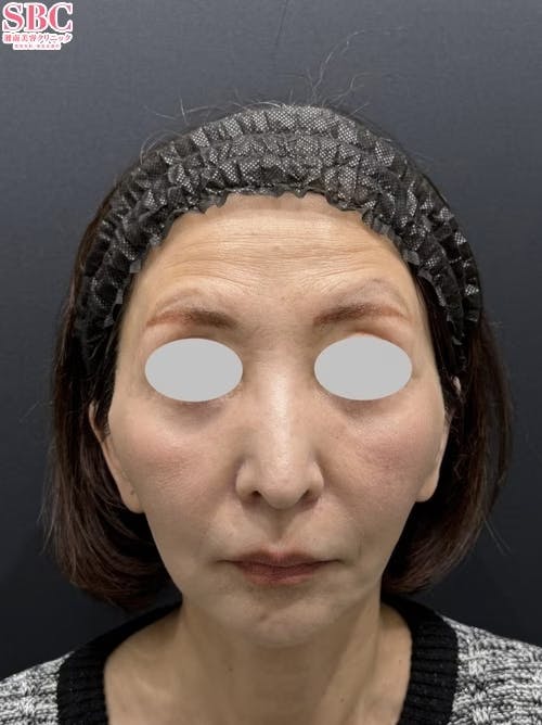 【60代女性・輪郭】スマスフェイスリフト_after