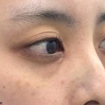 【女性・クマ】目の下の切らないクマ・たるみ(ふくらみ)取り ナチュラル脂肪注射コンデンスリッチ_before