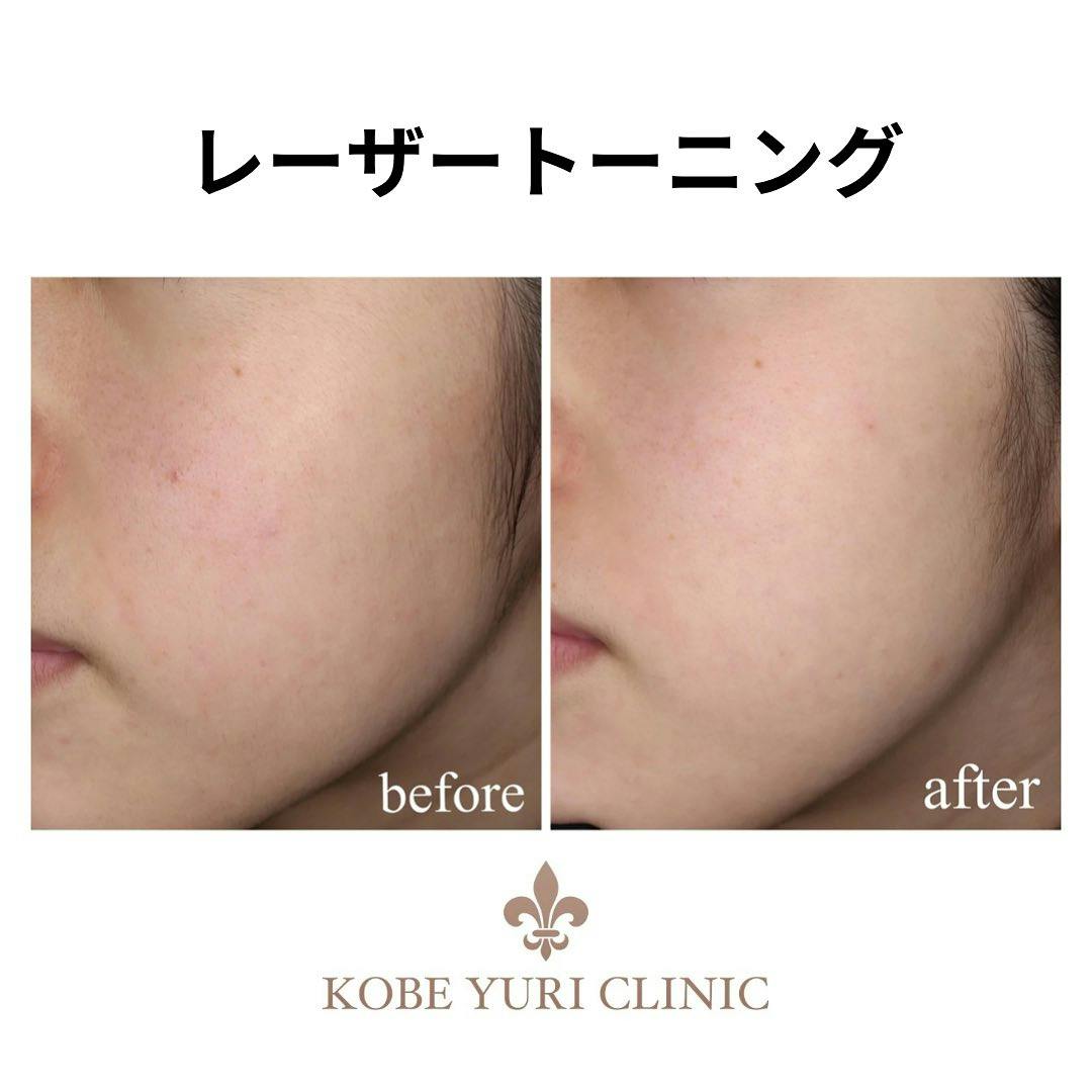 【女性・顔】レーザートーニング_before_aftar