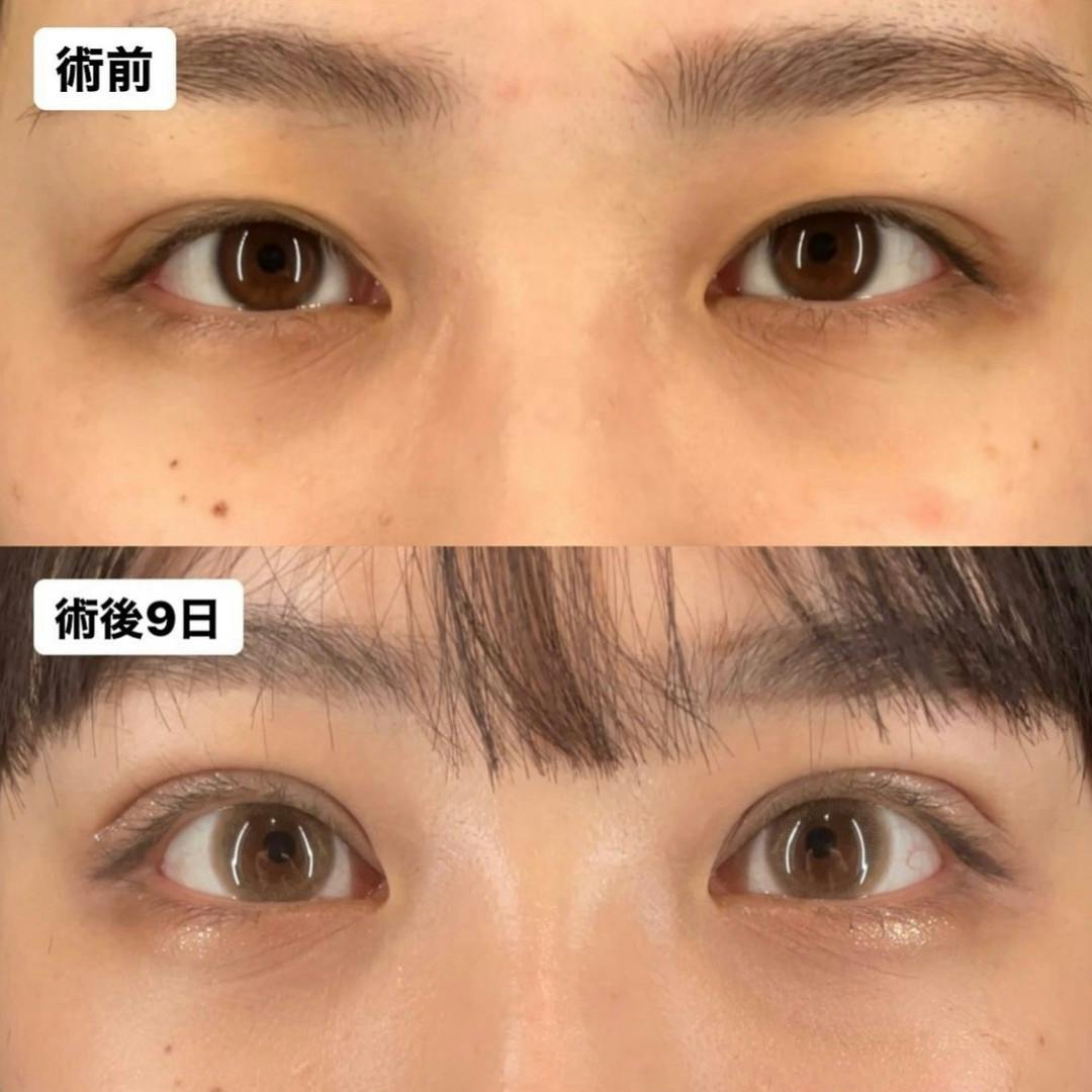 【女性・目元】Xクロスダブル(埋没二重)_before_aftar