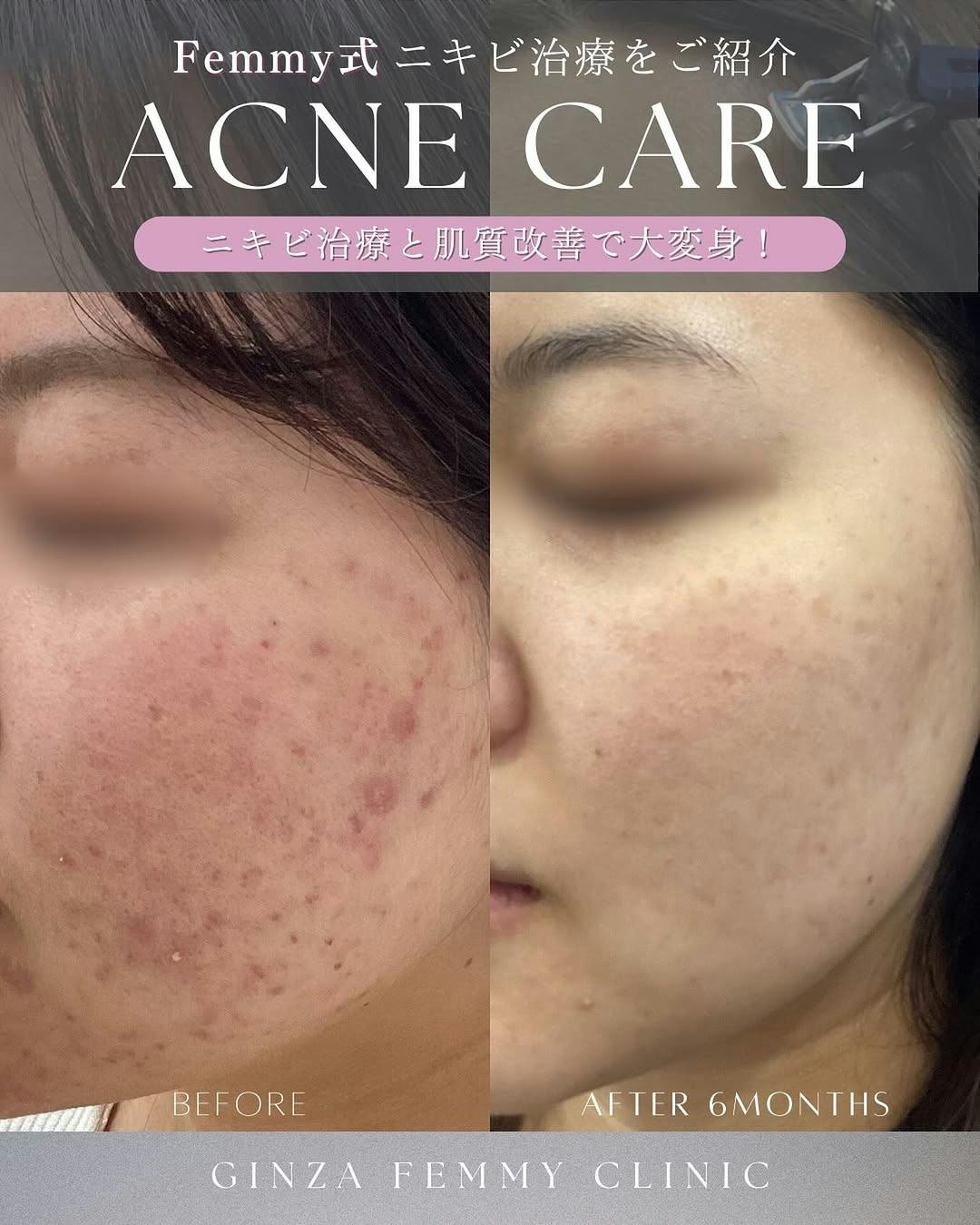 【女性・ニキビ】ニキビ治療・肌質改善_before_aftar