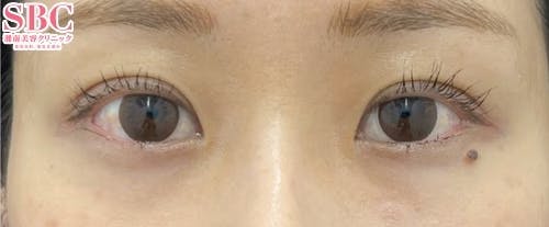 【女性・目元】 クイックコスメティーク・ダブルNeo_after