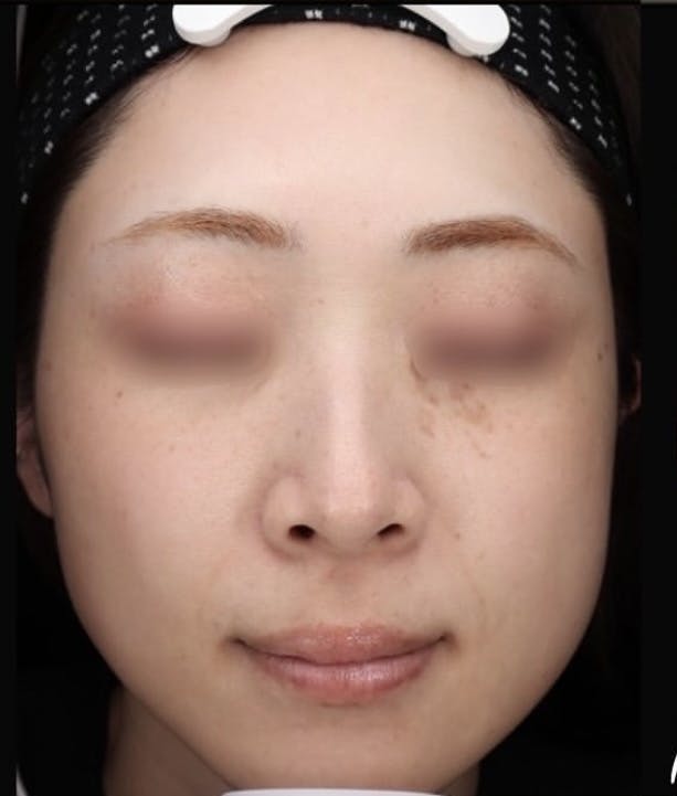 【女性・エラ】エラボトックス_b1