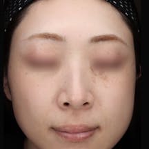 【女性・エラ】エラボトックス_b1