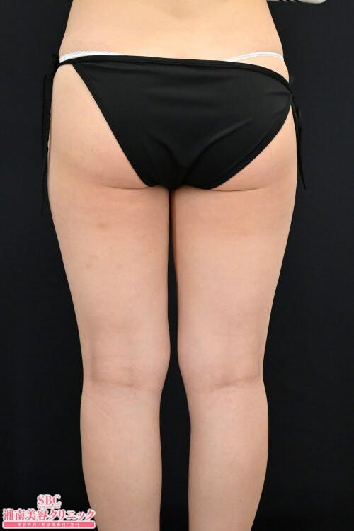 【20代女性・下半身】トゥルースカルプiD_before