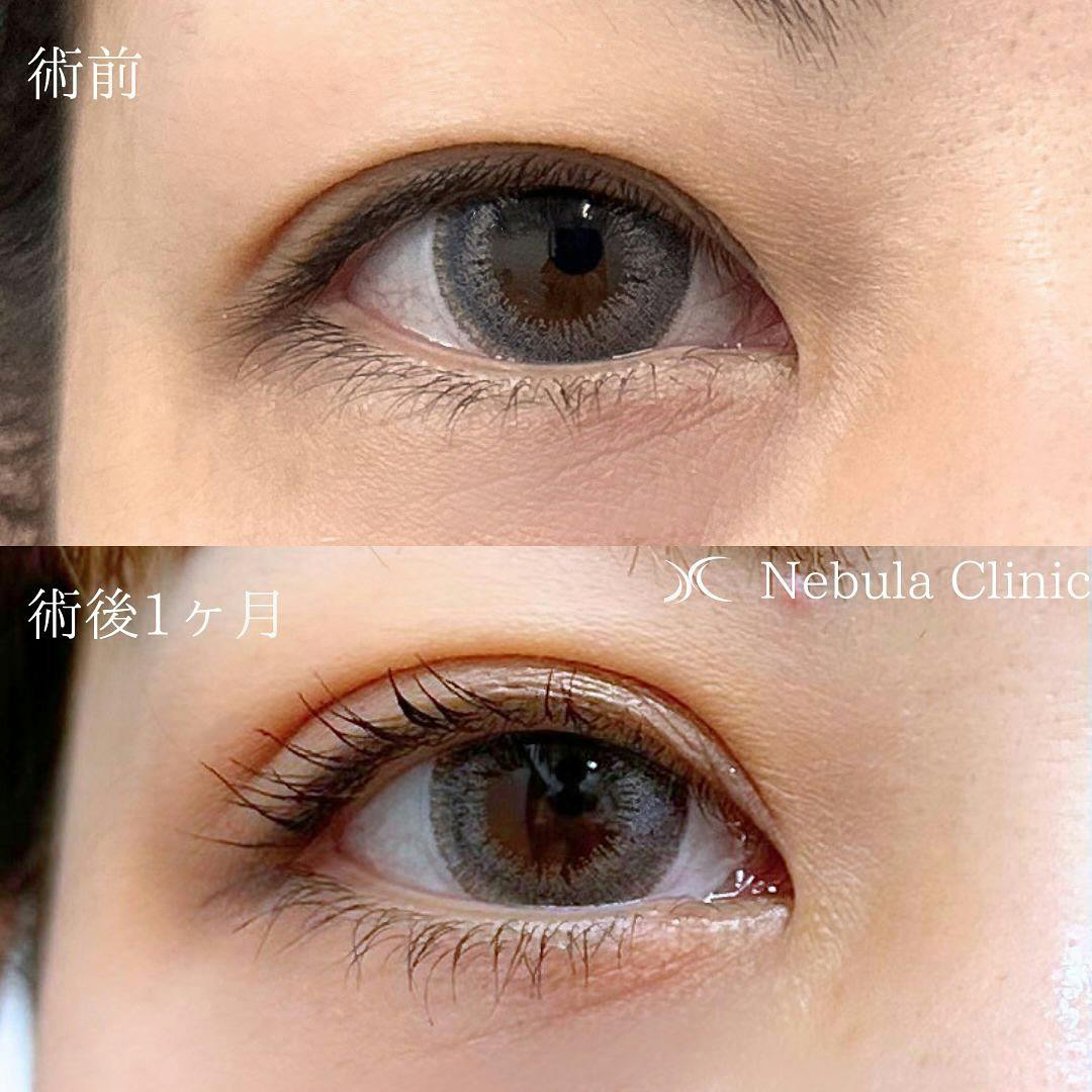 【女性・目元】二重埋没法_before_aftar