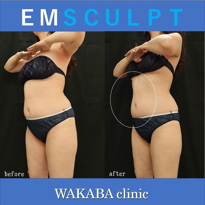【50代女性・腹部】EMSUCULPT_before_aftar