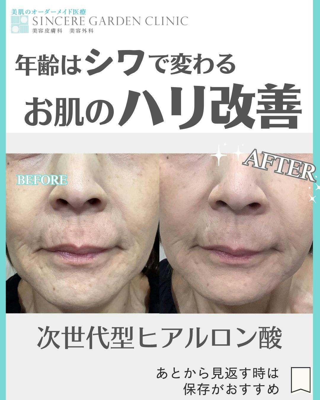 【女性・ハリ】プロファイロ_before_aftar