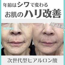 【女性・ハリ】プロファイロ_before_aftar