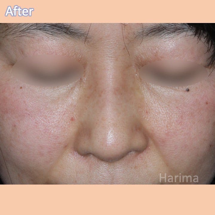 【女性・鼻】斜鼻・鼻閉手術_aftar