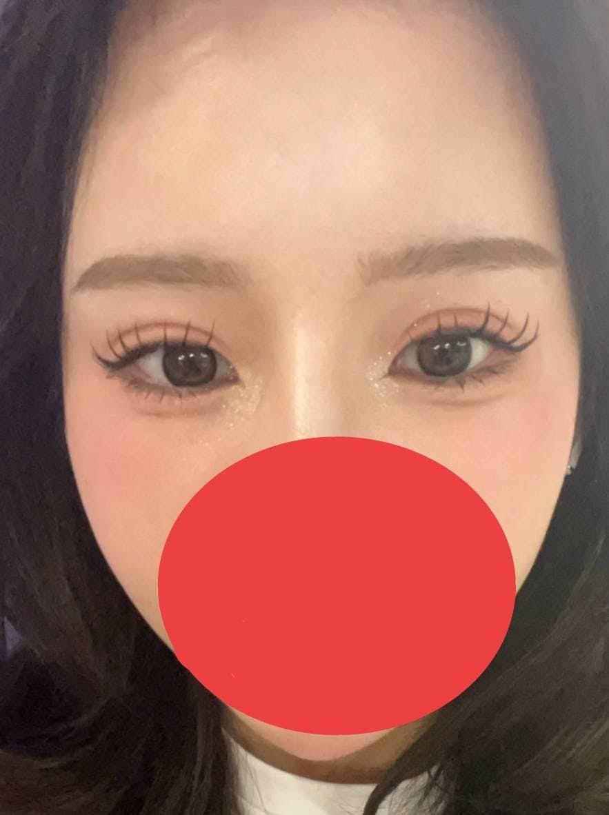 TCB東京中央美容外科 心斎橋院で二重埋没：1dayクイックアイ プレミアムエタニティを受けたみきTさんの写真