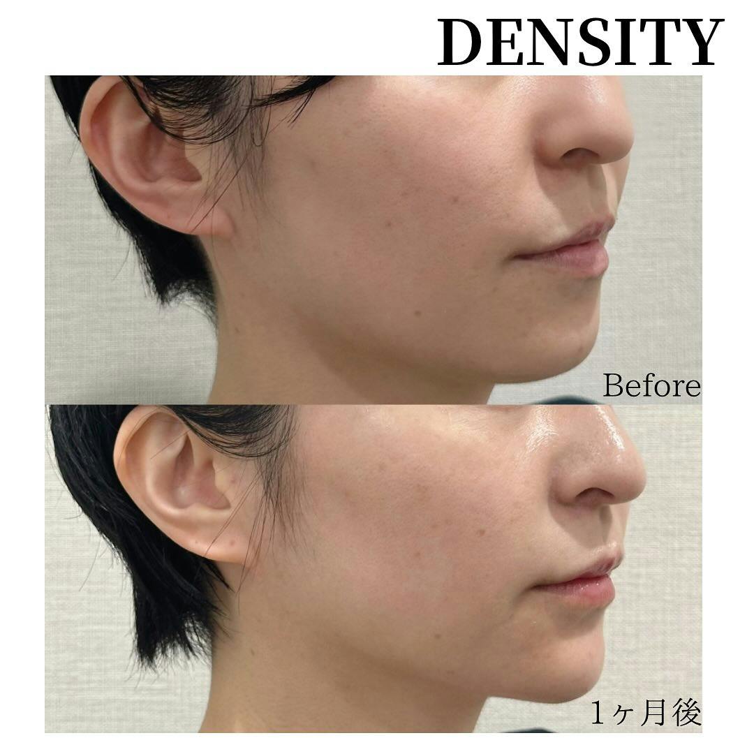 【女性・顔・顎】DENSITY(デンシティ)、顎ヒアルロン酸_before_aftar