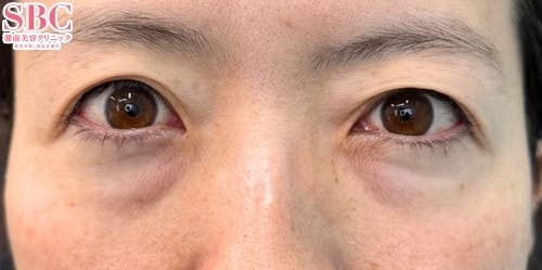 【40代女性・クマ】目の下の切らないクマ・たるみ（ふくらみ）取り_before
