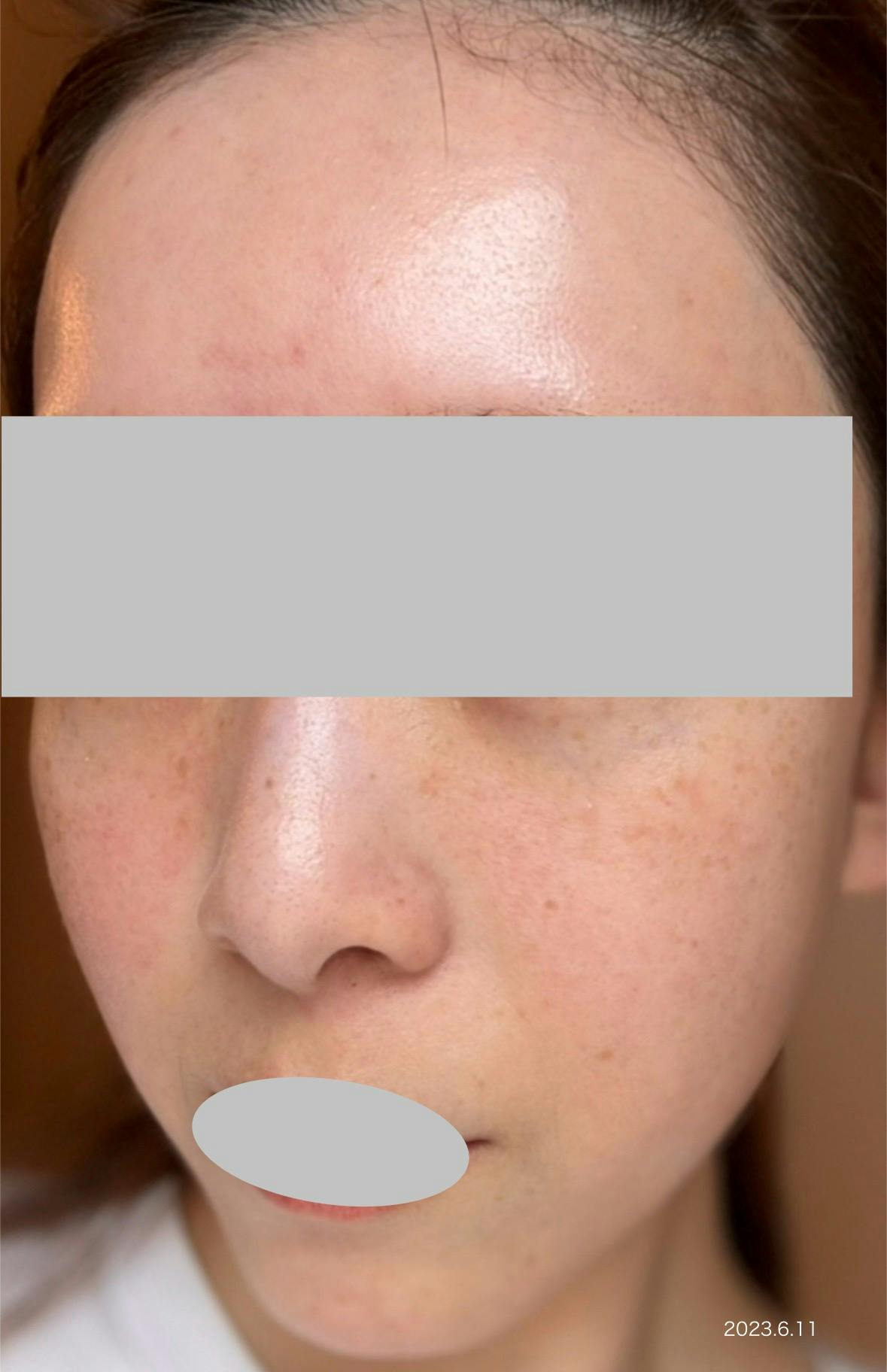 ルラ美容クリニック 渋谷本院でを受けたarai03さんの写真