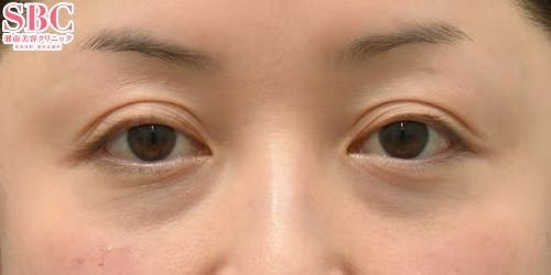 【女性・目元】目の下の切らないクマ・たるみ（ふくらみ）取り、ナチュラル脂肪注射コンデンスリッチ、ナチュラル脂肪注射ナノリッチ_before