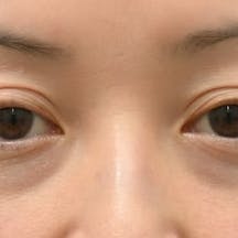 【女性・目元】目の下の切らないクマ・たるみ(ふくらみ)取り、ナチュラル脂肪注射コンデンスリッチ、ナチュラル脂肪注射ナノリッチ_before