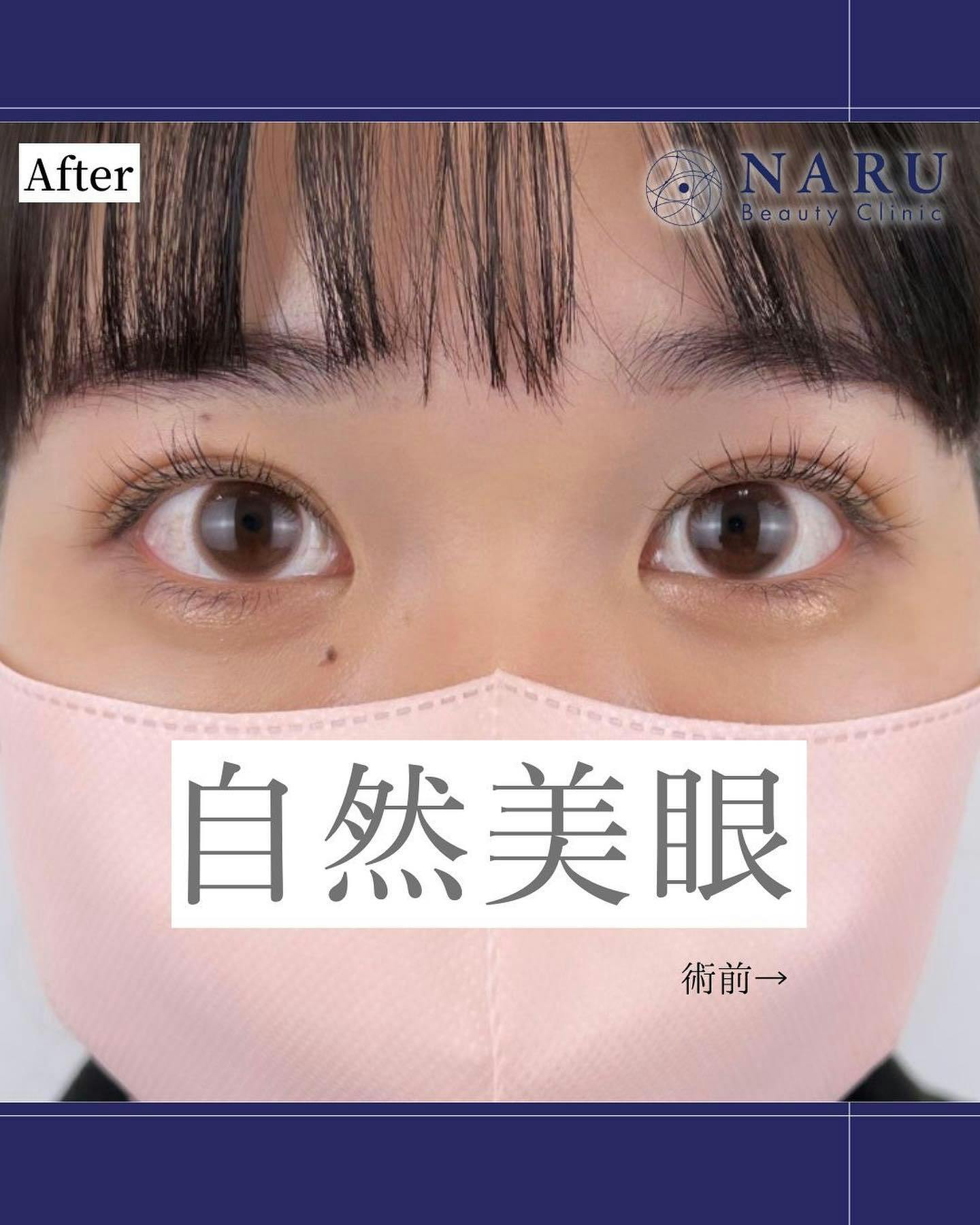 【女性・目元】二重埋没法_after