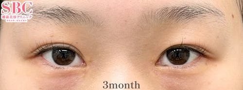 【10代女性・目元】目頭切開プレミアム・線留めクロス二重術_after