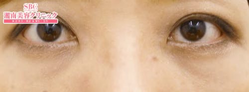 【女性・たるみ】目の下の切らないクマ・たるみ（ふくらみ）取り、切開ハムラ(表ハムラ)法、裏ハムラ法_after