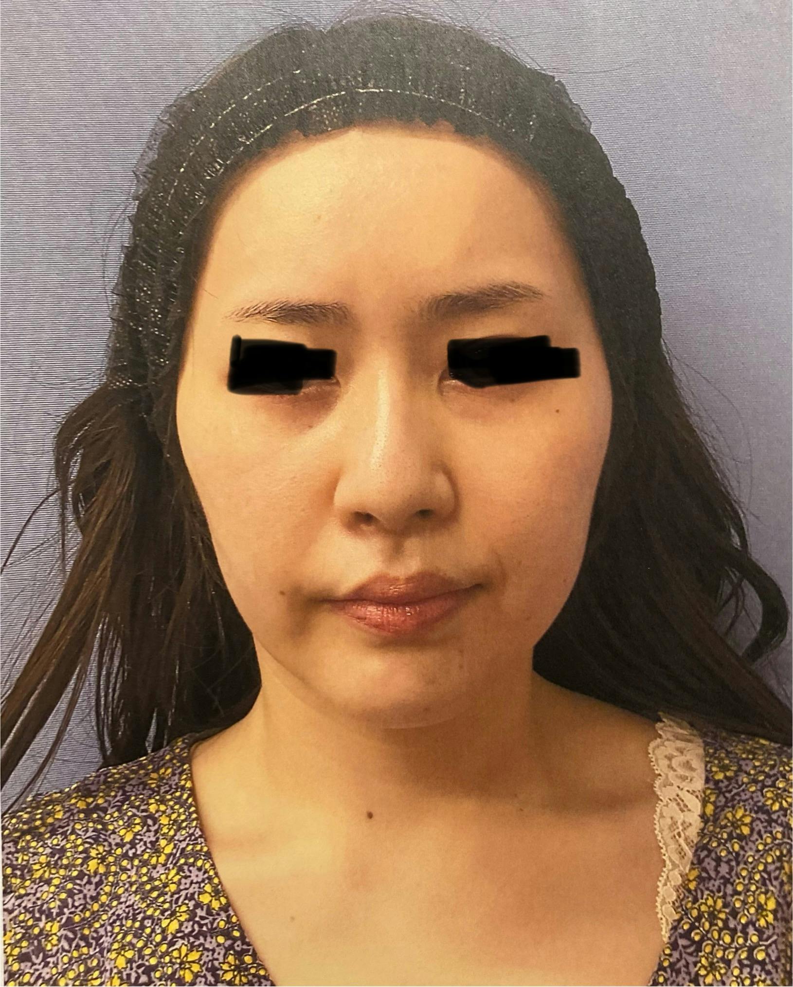 湘南美容クリニック 品川院で目の下の切らないクマ・たるみ（ふくらみ）取り　裏ハムラ法を受けたpeanutsさんの写真