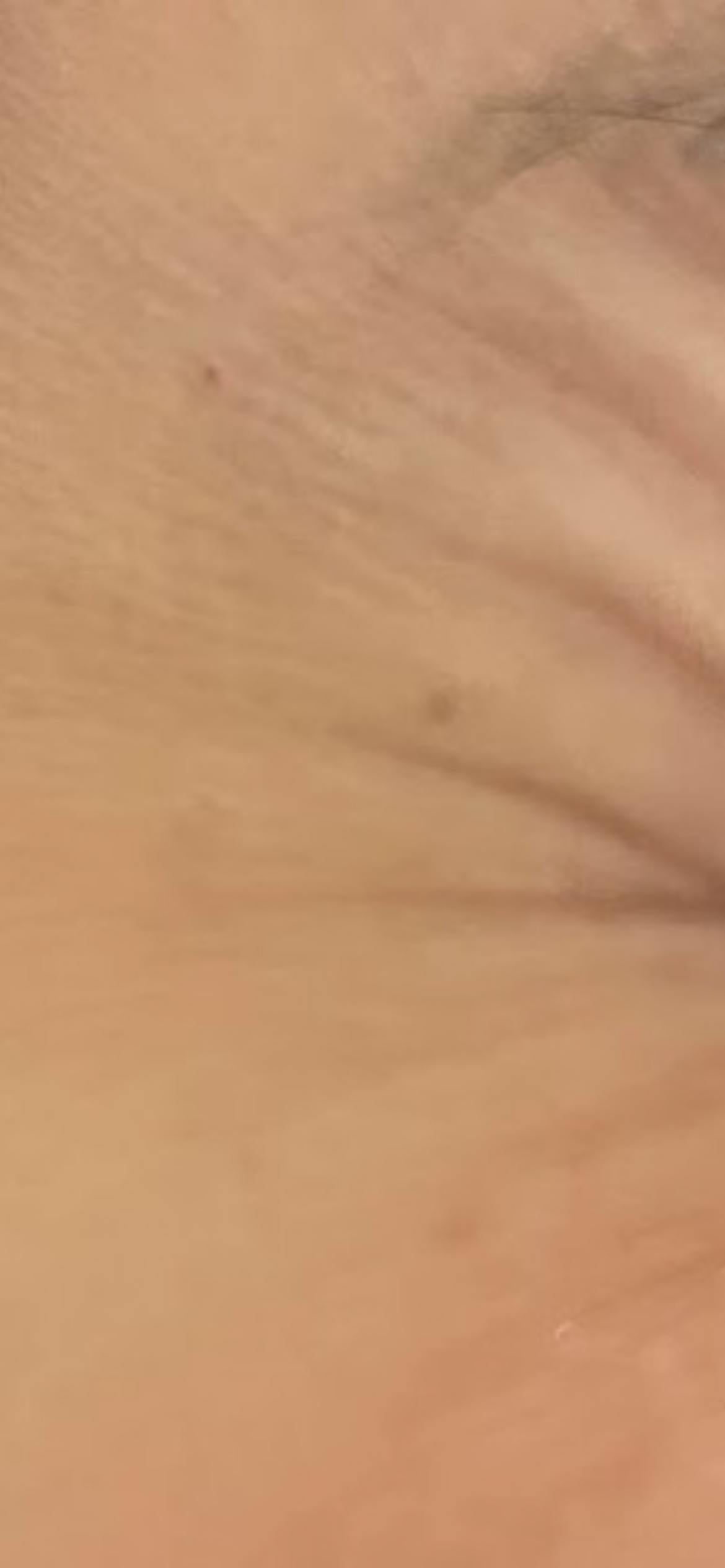 湘南美容クリニック 横浜院で目の下のクマ・たるみ取り・ボトックス注射・ボトックス注射(顎)・目尻ボトックス注射・眉間ボトックス注射・目の下ボトックス注射・おでこ(額)ボトックス注射・バニーライン・鼻根ボトックス注射・韓国製ボトックス・ボツリヌストキシン・クマ取り注射・アラガン製ボトックスを受けたはちわれさんの写真