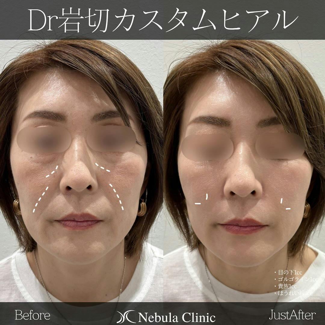 【女性・目の下・ゴルゴライン・小鼻・法令線】ヒアルロン酸注入(目の下、ゴルゴライン、貴族、法令線)_before_aftar