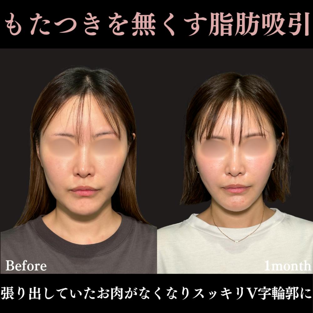 【30代女性・顔】脂肪吸引プレミアム（頬・顎下）＋糸リフト_before_aftar