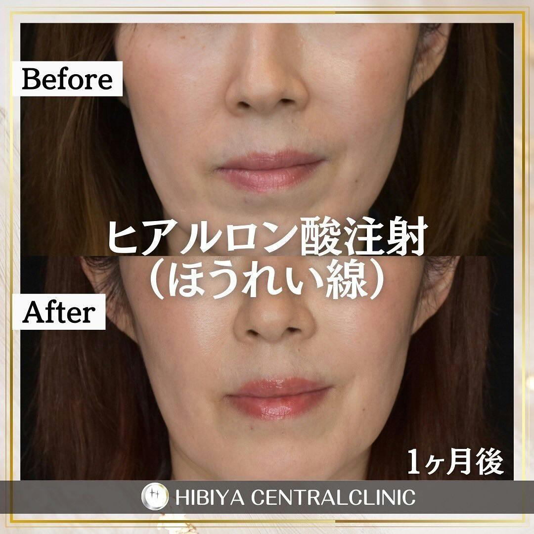 【女性・ほうれい線】ヒアルロン酸注射_before_aftar