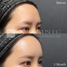 【20代女性・額】ベイビーおでこ+PRP_before_aftar