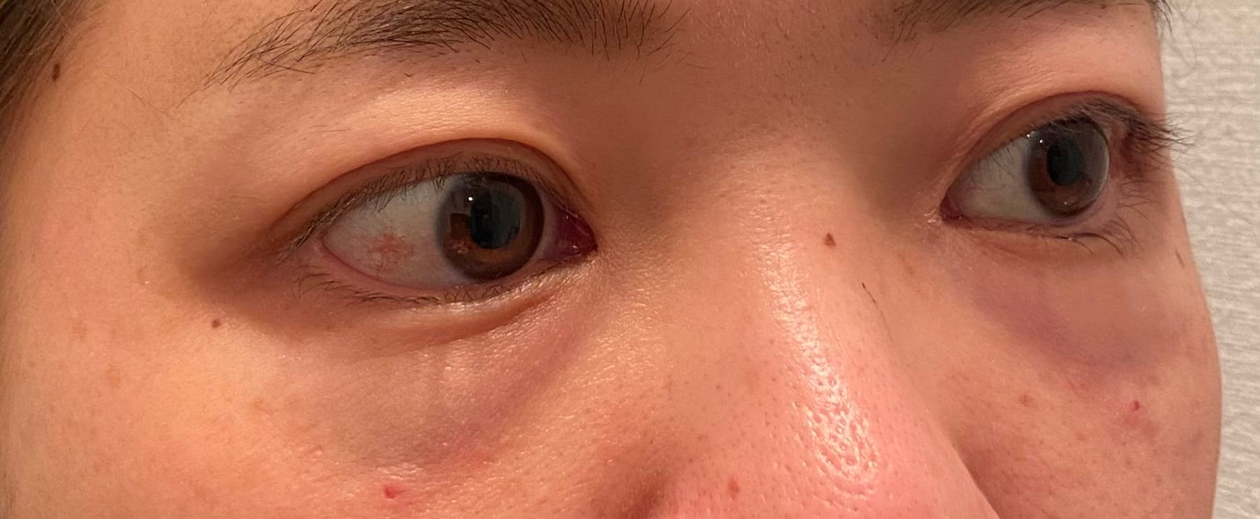 コスメディカルクリニック シンシア 渋谷院で目の下のクマ・たるみ取り・経結膜脱脂法・目元整形を受けたゆっきーさんの写真