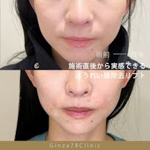 【女性・ほうれい線】スマイルラインスレッド_before_aftar