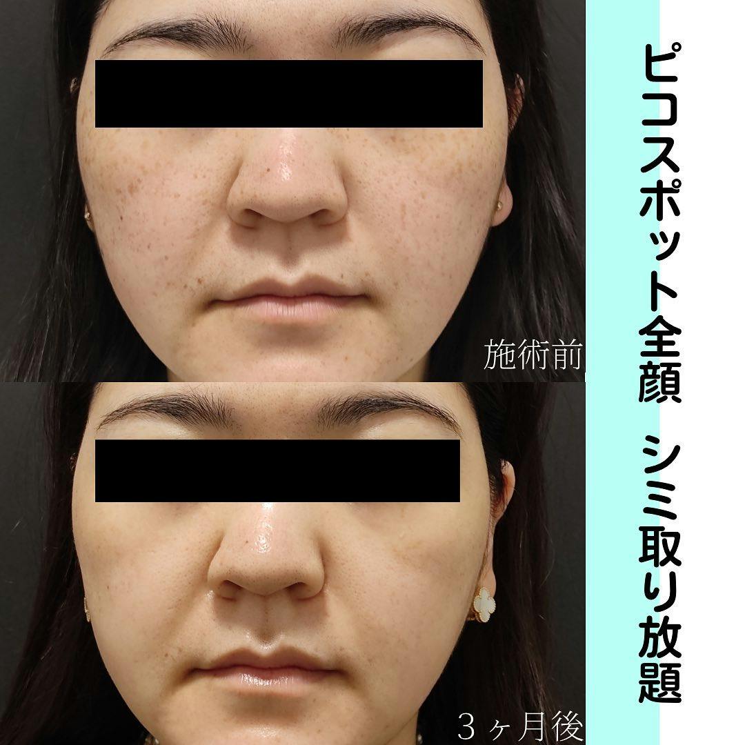 【女性・頬】ピコスポット全顔_before_aftar