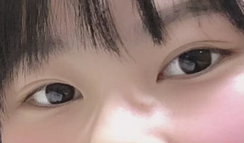 湘南美容クリニック 名古屋駅本院で涙袋ヒアルロン酸を受けたあいさんの写真