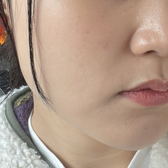 吉田皮ふ科・形成外科クリニックでほくろ取りを受けたななこさんの写真