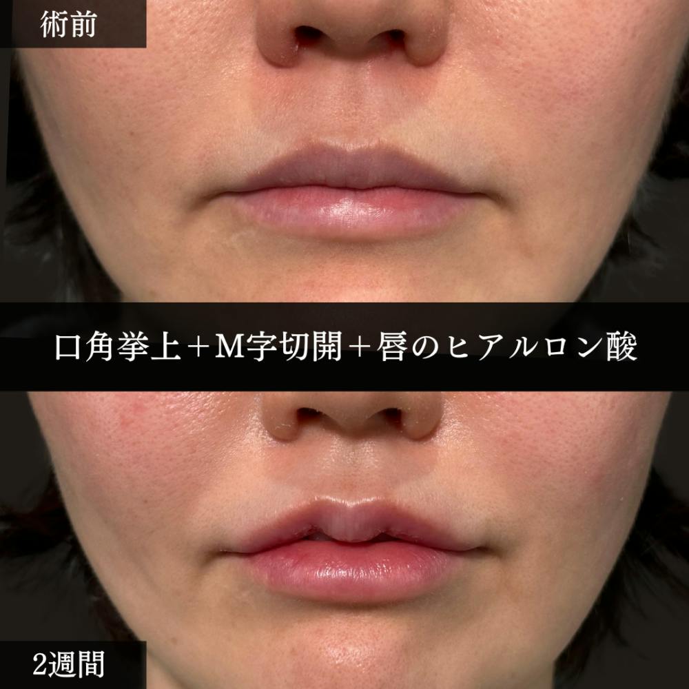 【30代女性・口】口角挙上＋M字リップ＋唇のヒアルロン酸注射_before_aftar