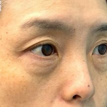 【女性・目元】ナチュラル脂肪注射、目の下の切らないクマ・たるみ(ふくらみ)取り_before