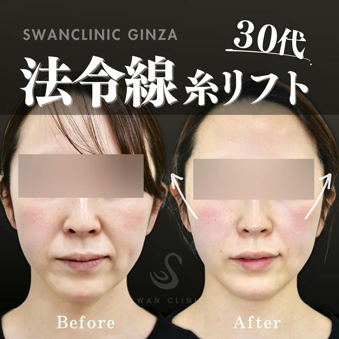 【30代女性・法令線】法令線の糸リフト複合治療_before_aftar