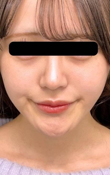 聖心美容クリニック 銀座院でフェイスリフト：顔脂肪吸引＋糸リフトを受けたはじもさんの写真