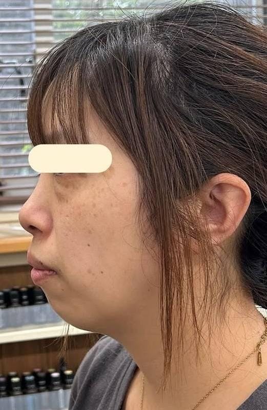 東京美容外科 新宿院でHIFU（ハイフ）：ウルトラセルQプラス（HIFU）リフトアップ ［ドット］を受けたまつげちゃんさんの写真