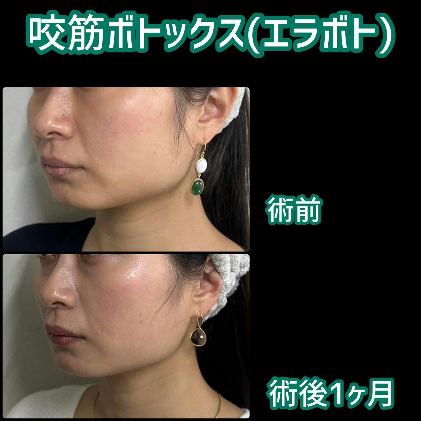 【女性・エラ】咬筋ボトックス(エラボト)_before_aftar
