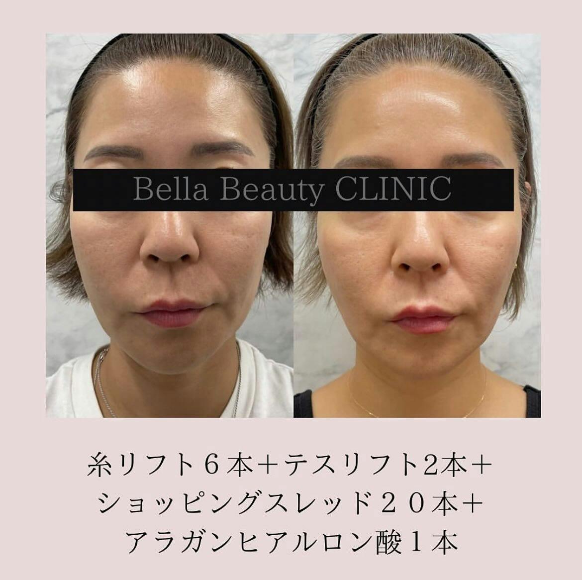 【女性・たるみ】糸リフト（フェイスライン）_before_aftar