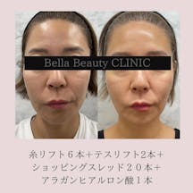 【女性・たるみ】糸リフト(フェイスライン)_before_aftar