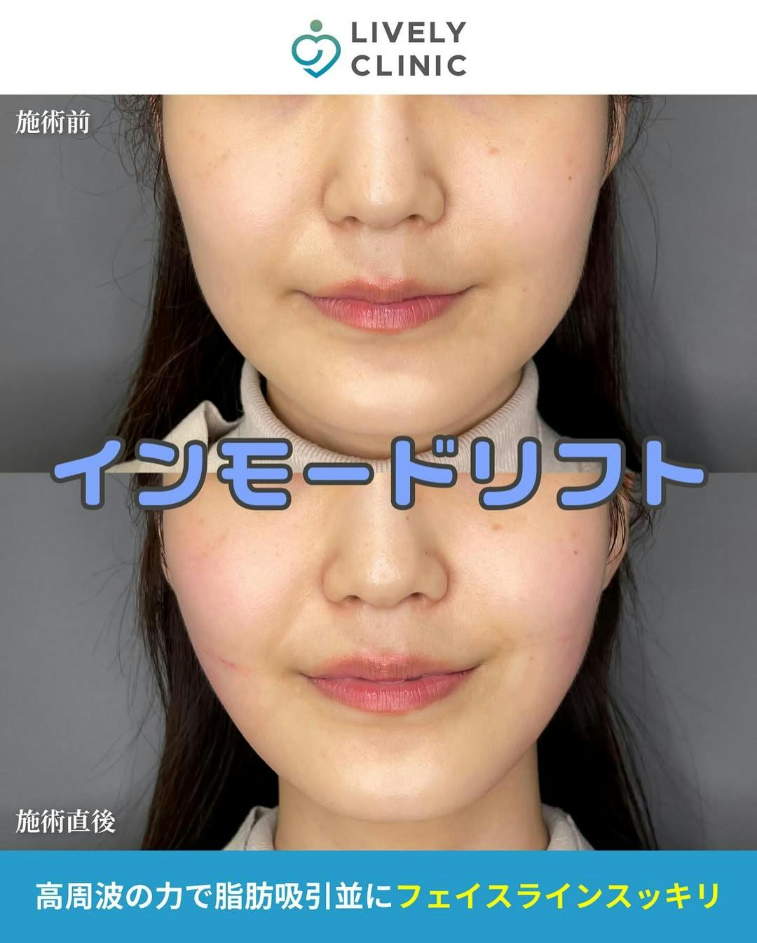 【女性・顔】インモードリフトbefore.after